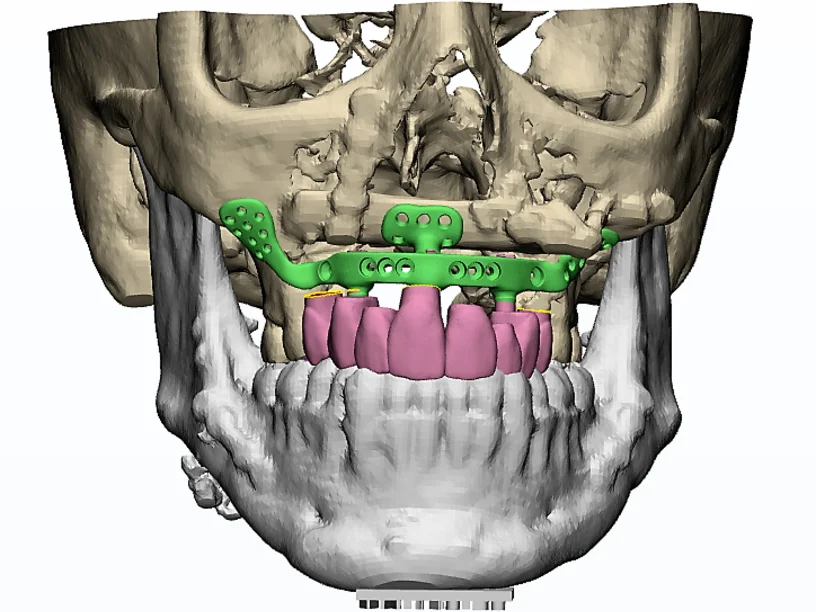 3d_printing_medical_craniomaxillofacial_surgery_scull.webp